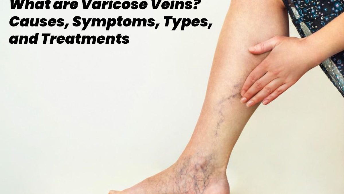 What are Varicose Veins? – Causes, Symptoms, Types, and Treatments
