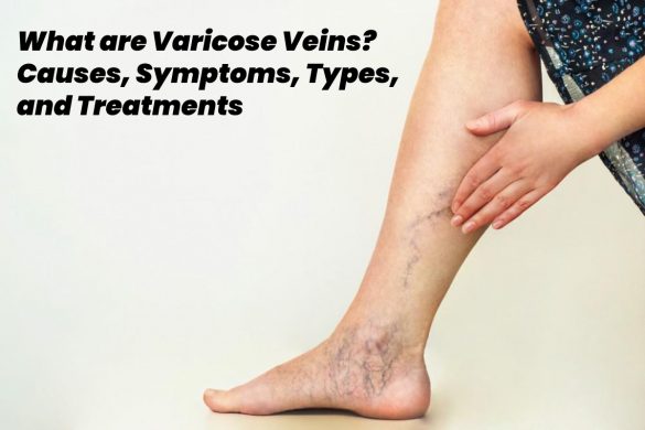 varicose veins