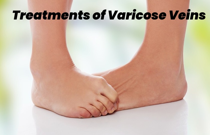 Treatments of Varicose Veins