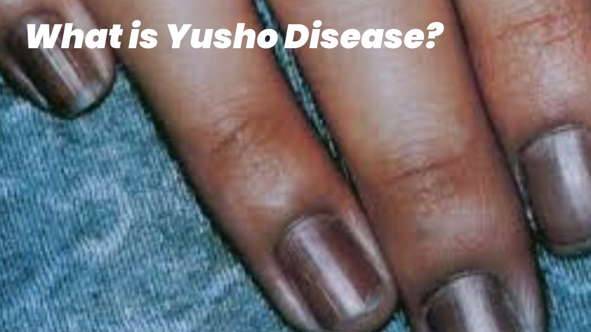 What is Yusho Disease? – Symptoms, Causes, and More