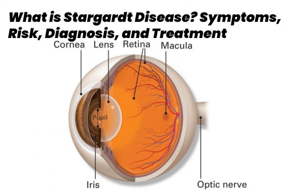 stargardt disease