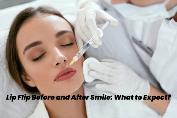 lip flip before and after smile