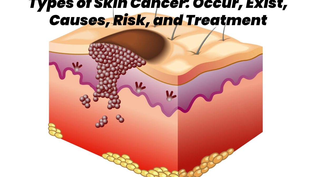 Types of Skin Cancer – Occur, Exist, Causes, Risk, and Treatment
