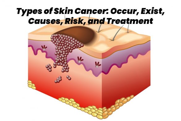 types of skin cancer