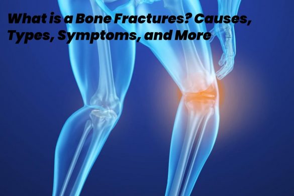 bone fractures
