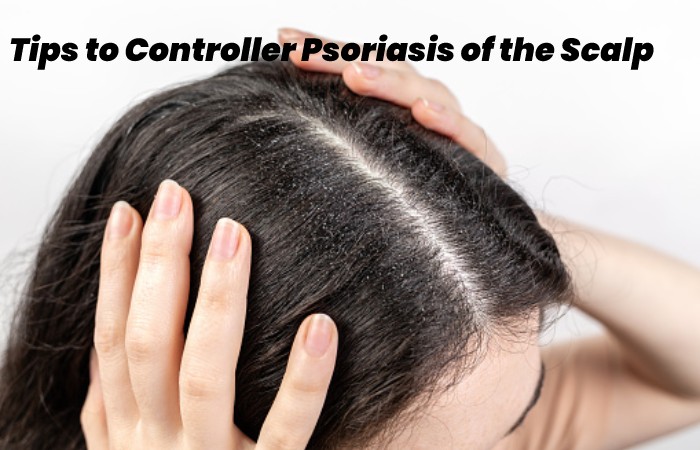 Tips to Controller Psoriasis of the Scalp