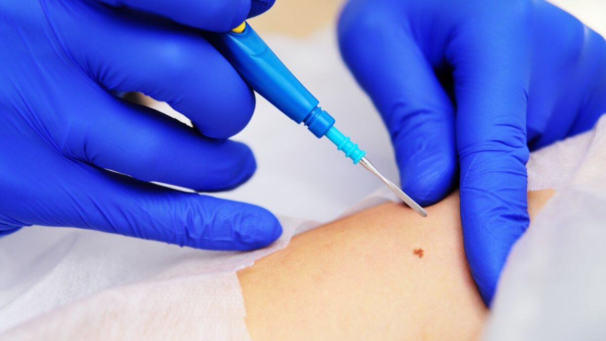 skin biopsy