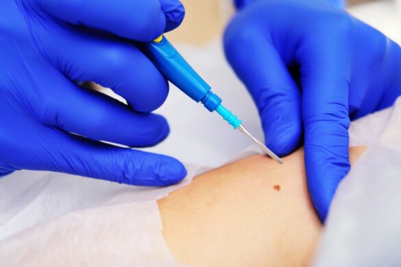 skin biopsy