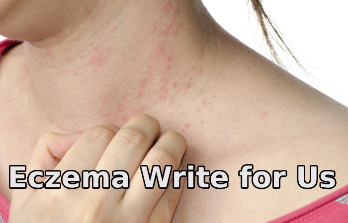 Eczema Write for Us