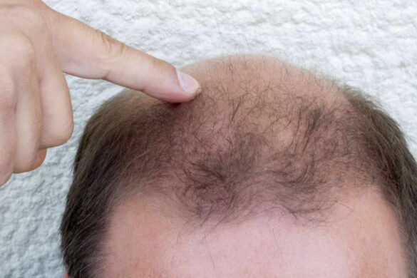 hair restoration