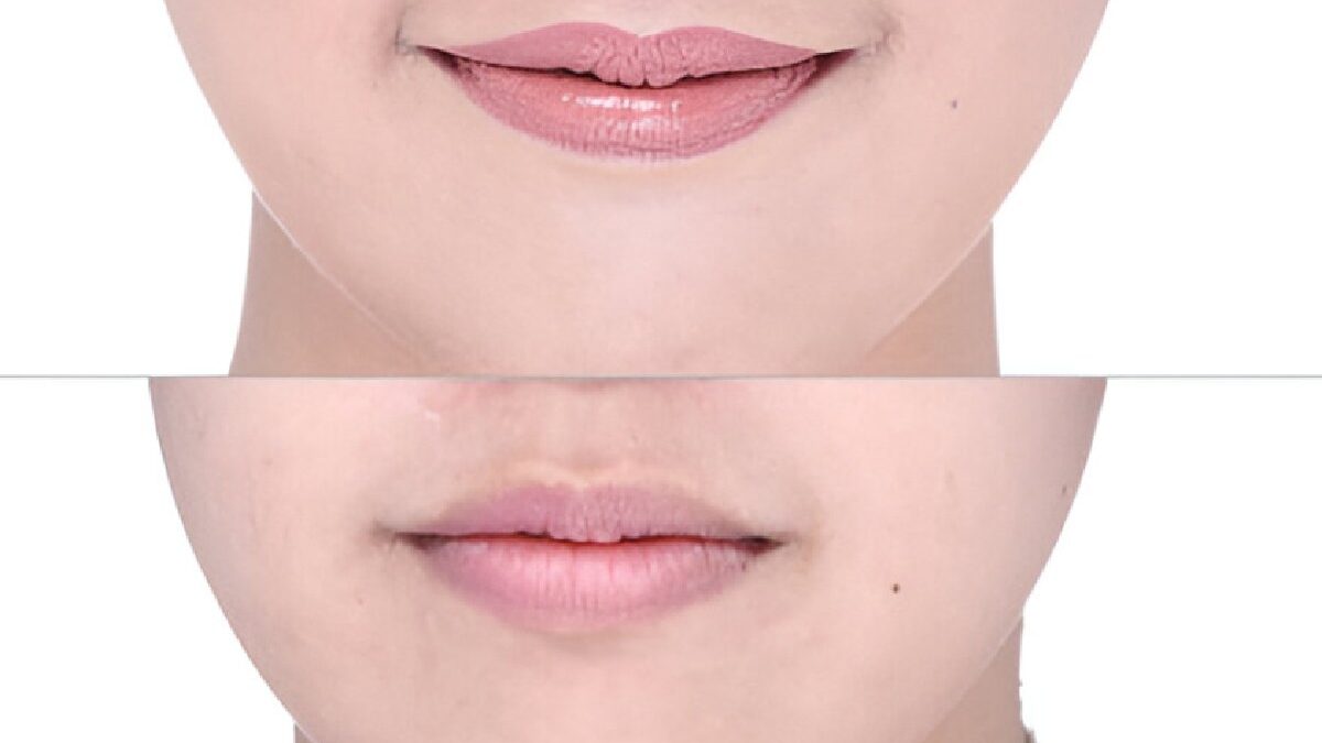 Lip Flip Before and After Smile – What to Expect?