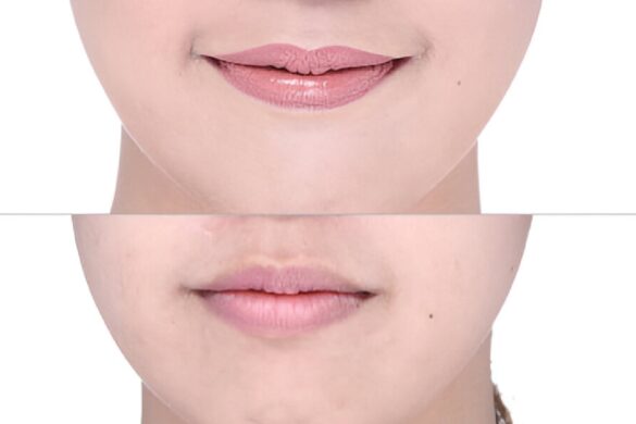 lip flip before and after smile