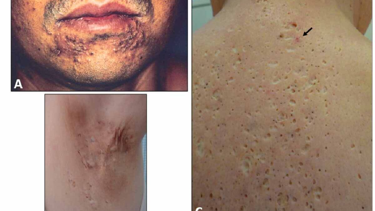What is Yusho Disease? – Symptoms, Causes, and More