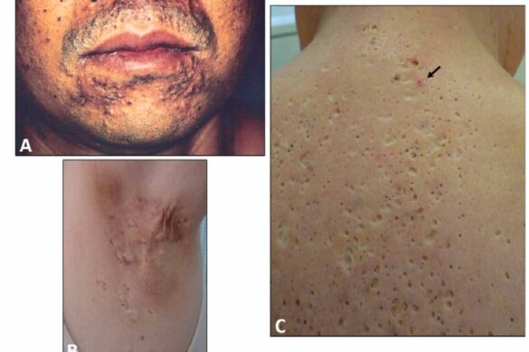 yusho disease